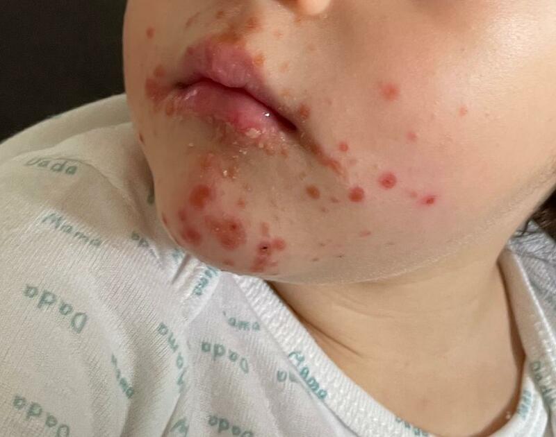 content_Síndrome_mão-pé-boca