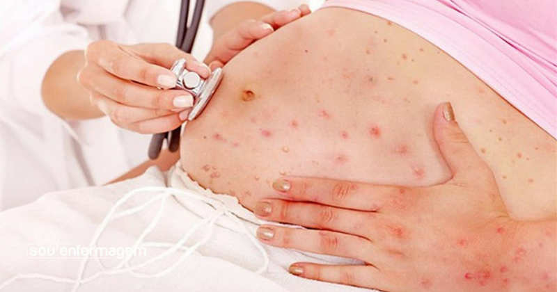 1510-HMNSL_SifilisSifilisCongenita