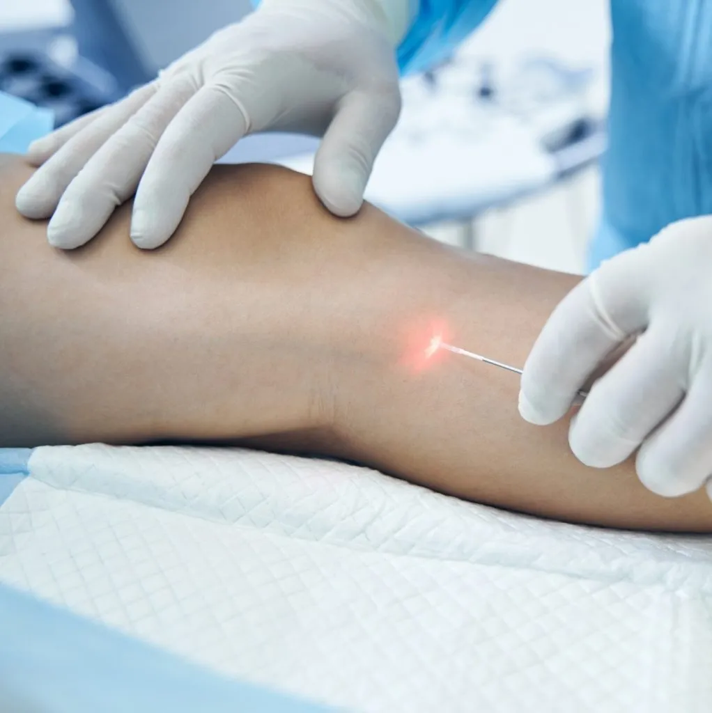 Afinal, como é o procedimento endolaser?