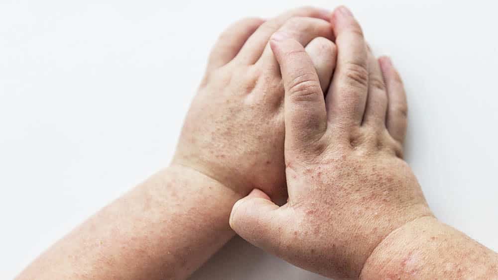 201903_drauzio_escarlatina_201900666_anastasiyparfenyuk_1000x563 Casos de escarlatina aumentam 600% no último ano em Jacareí