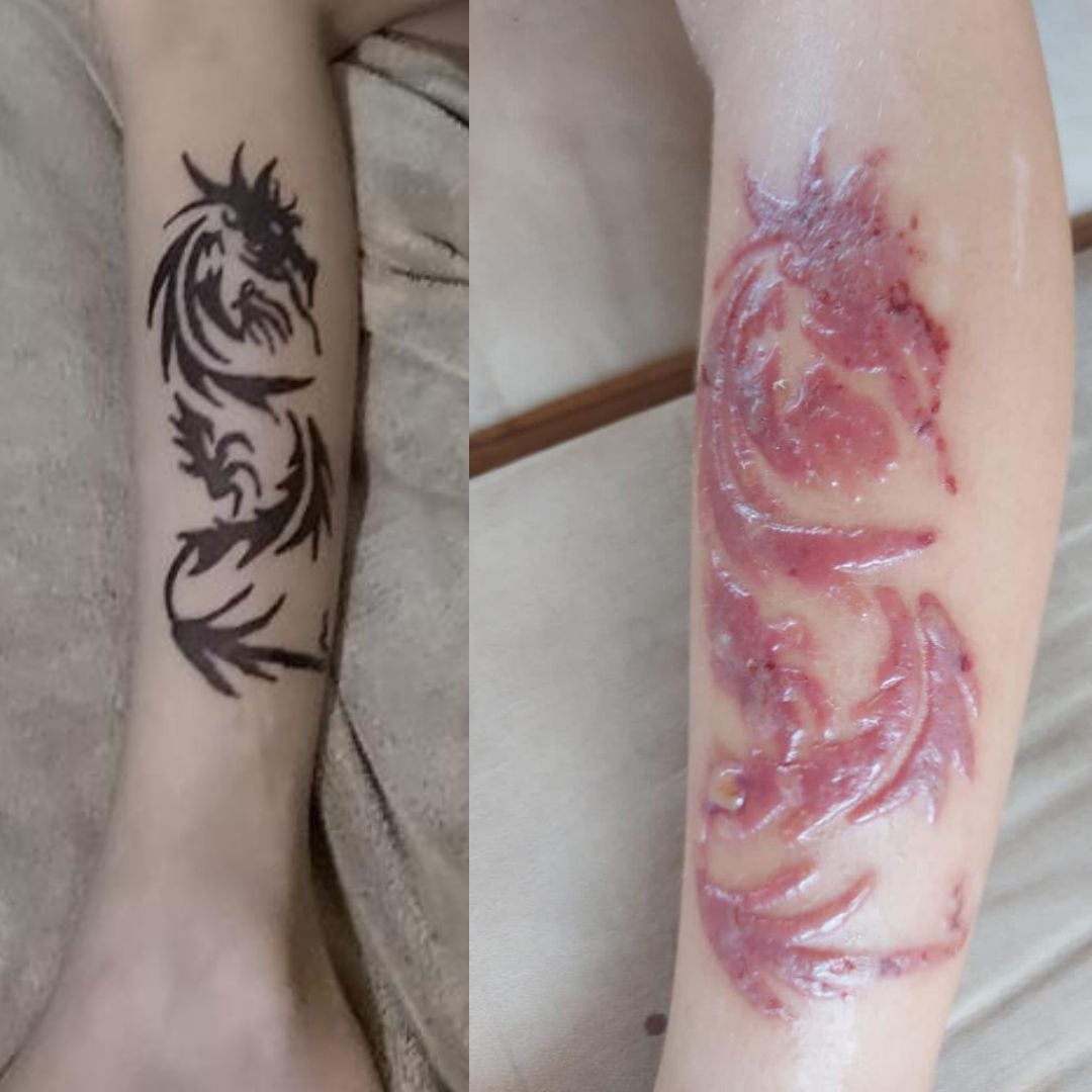 Alerta verão: menino de 8 anos tem reação alérgica após fazer tatuagem de henna Alerta verão: menino de 8 anos tem reação alérgica após fazer tatuagem de henna