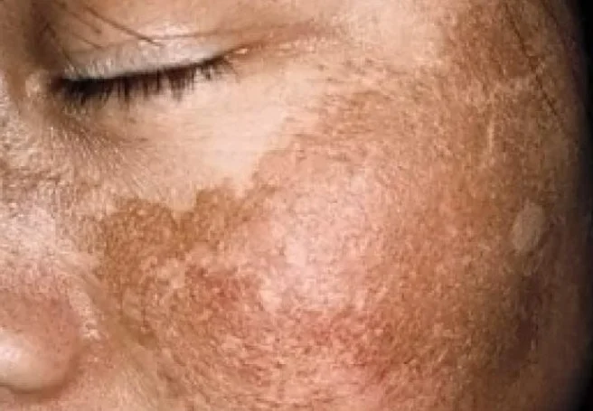 Denise Steiner: “Trate o melasma antes dele se tornar crônico”