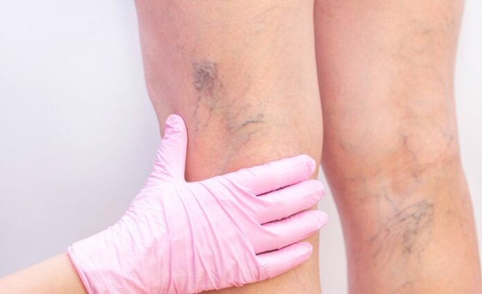 Quando a pele fala pelas veias: sinais que podem indicar doenças vasculares graves