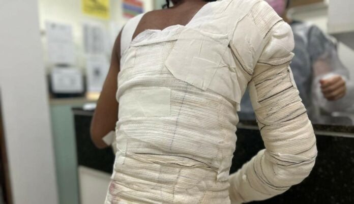 queimaduras Secom PB Os números reforçam a preocupação. Até 9 de dezembro de 2025, 1.091 vítimas de queimaduras foram atendidas no hospital