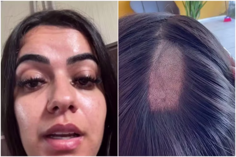 Laboratório reconhece falha após mulher ter parte da cabeça raspada durante exame para CNH na Paraíba