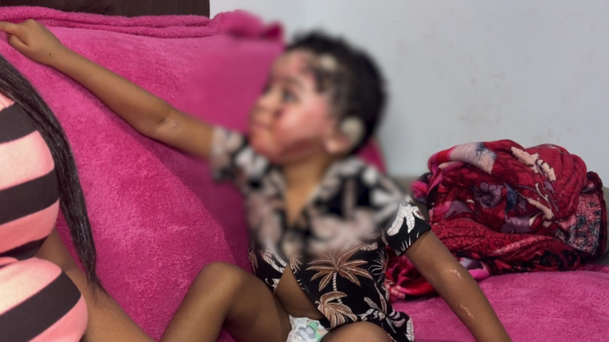 Criança que teve 36% do corpo queimado após explosão de tacho recebe alta em Valinhos